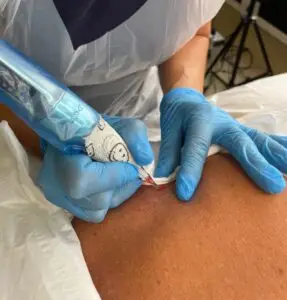 Saline Tattoo removal