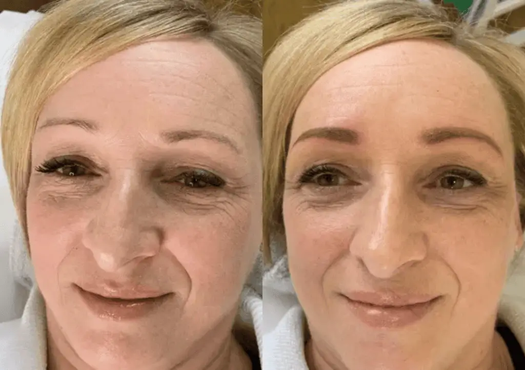 Before and after brows Treatment 1