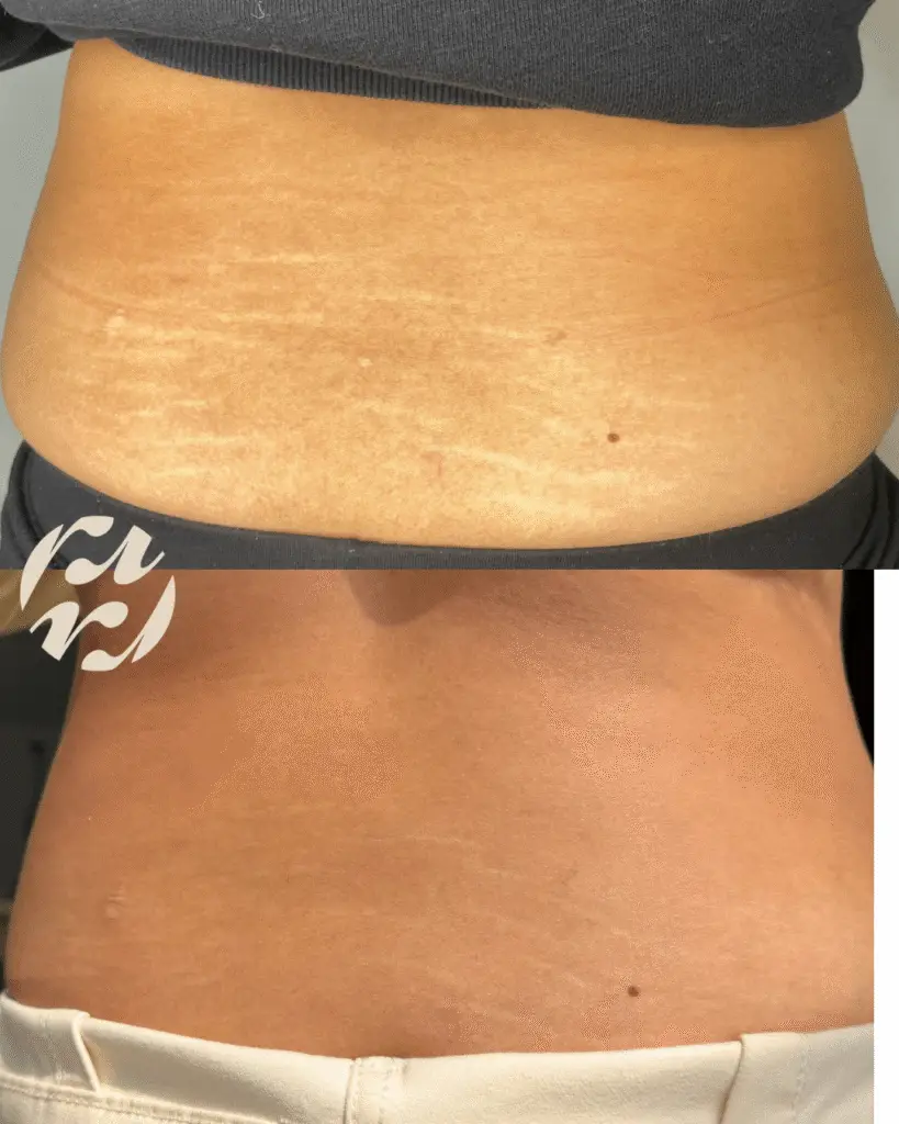 Stretch mark treatment Bagshot Surrey- before and after